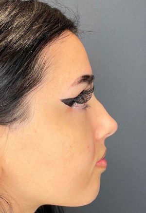 Before - Micro needling