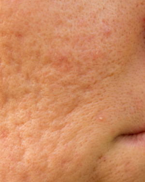 Acne Scarring