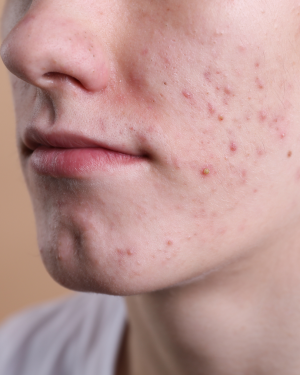 Acne
