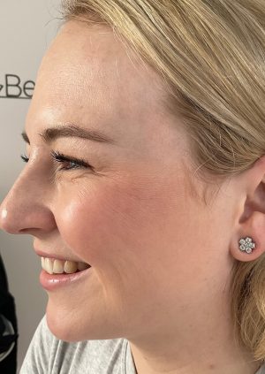 After - Crow's Feet Treatment