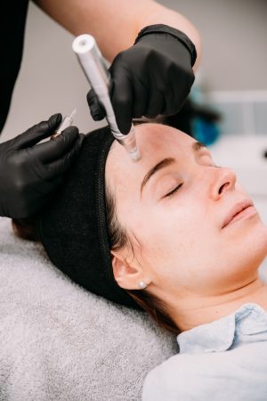 Microneedling