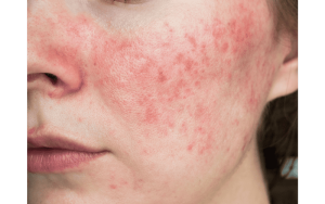 Rosacea