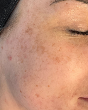 Hyperpigmentation