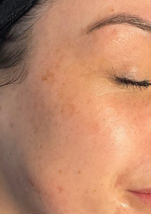 After - pHformula resurfacing