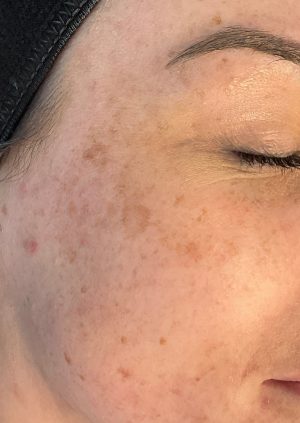 Before - pHformula resurfacing