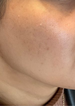 After - Polynucleotides Treatment