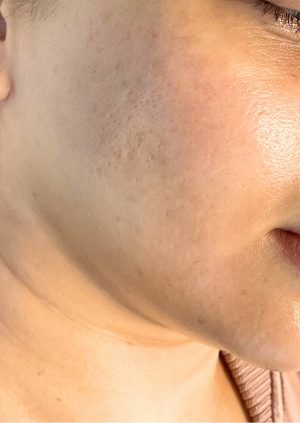 Before - Polynucleotides Treatment